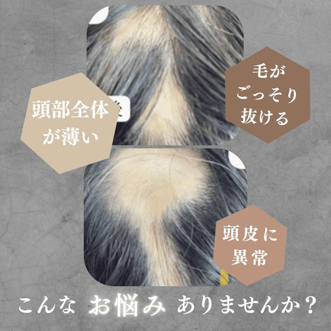 【新規限定】脱毛症体質改善コース 60分 通常料金16,800円