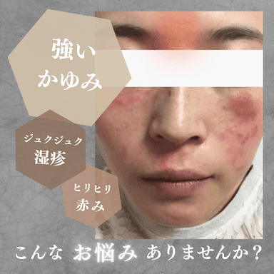 アトピー体質改善コース 