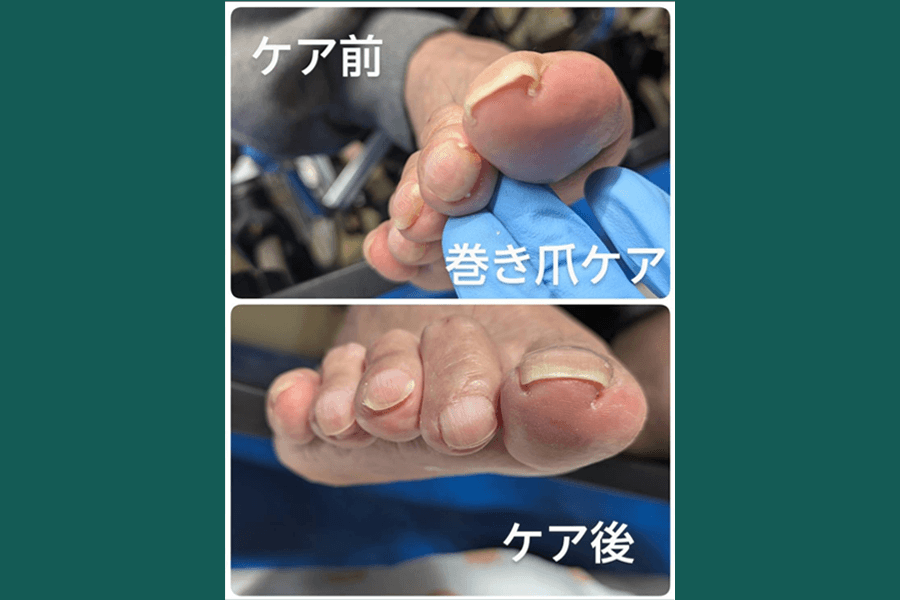 爪切り(トラブル爪・巻き爪) 60分