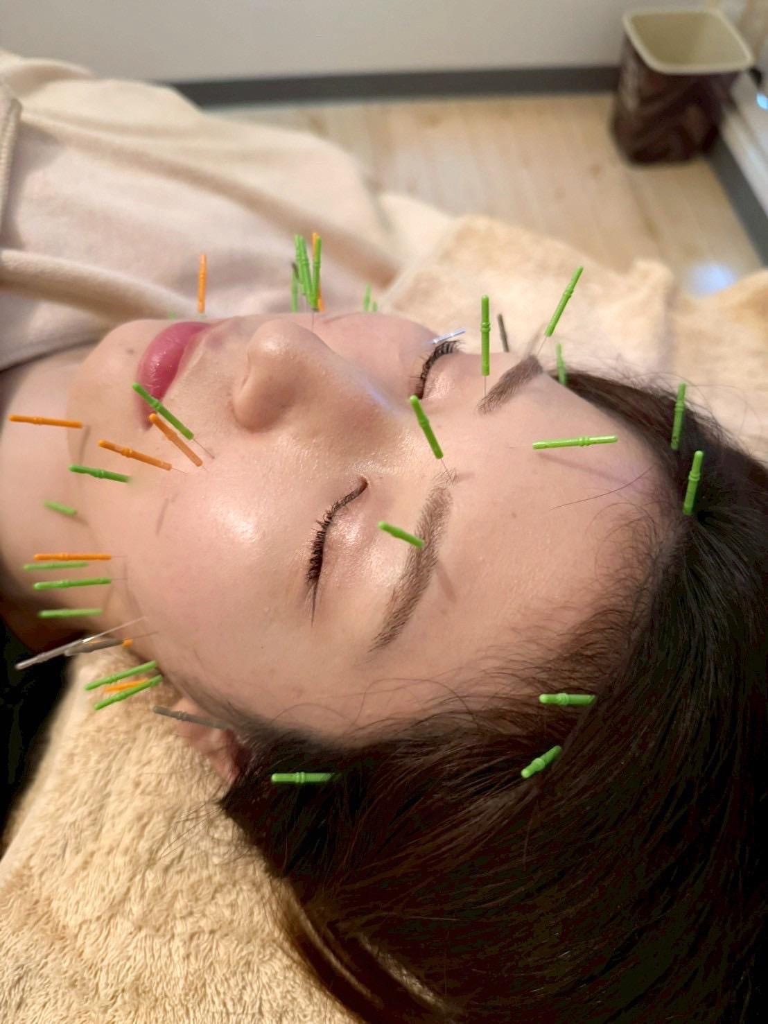 【新規限定】リフトアップ美容鍼 体験コース 90分通常料金12,000円