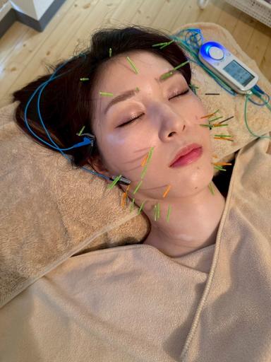 【新規限定】美容鍼＆ヘッドor電気鍼９０分コース通常料金16,500円