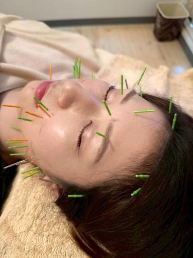 【新規限定】美容鍼 体験コース 90分通常料金12,000円