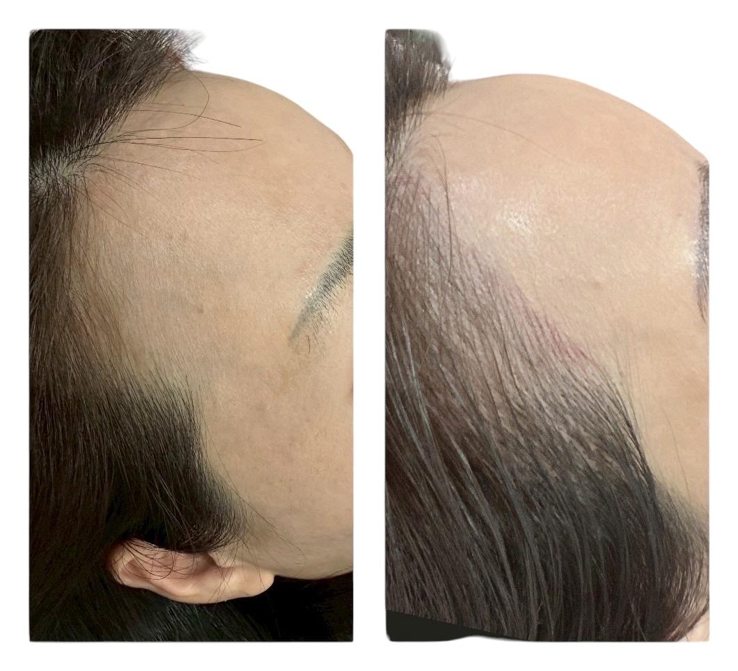 ヘアライン除去 90分