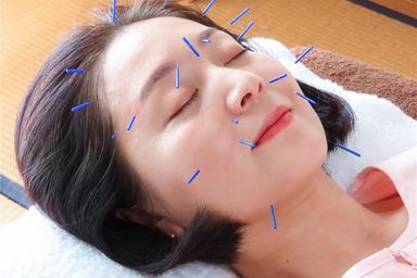 美容鍼+全身への施術とカッピング 60分