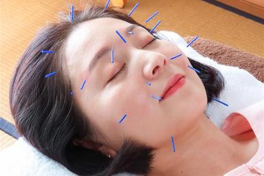 美容はり(お顔のみの施術) 30分