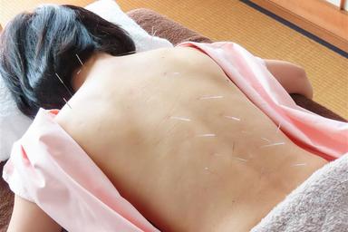 はり施術のみ 60分