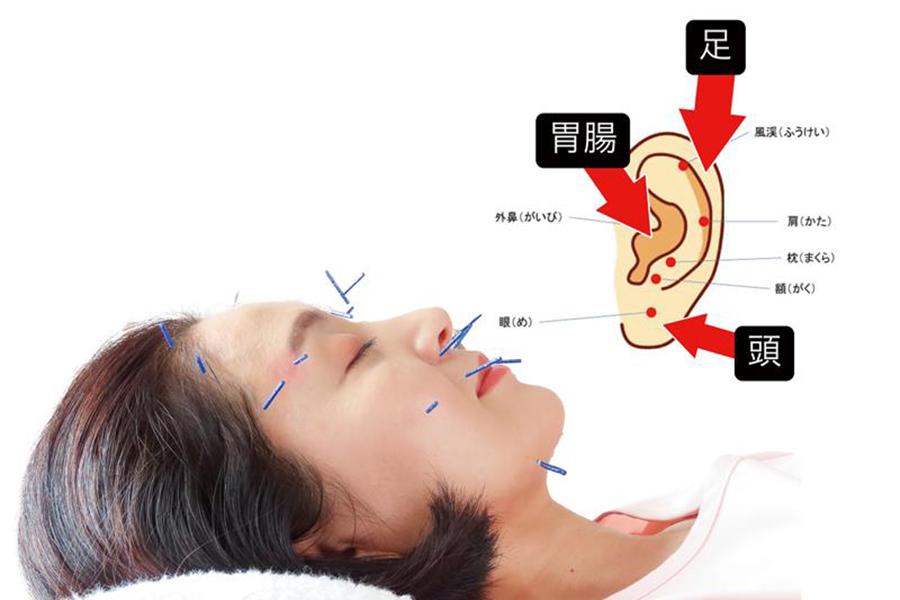 美容鍼＋耳つぼ施術 30分