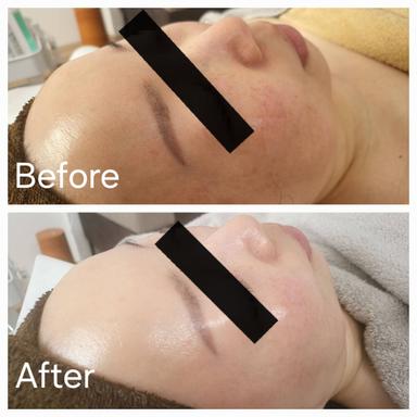 【高濃度ヒト臍帯血幹細胞培養液導入】CHILLトリートメント 口ポニョ・たるみ・目元くま