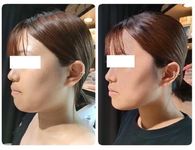 【10回コース】【小顔・たるみ改善】筋膜×筋肉アプローチ