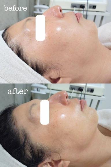 【6回コース】たるみ激変コース