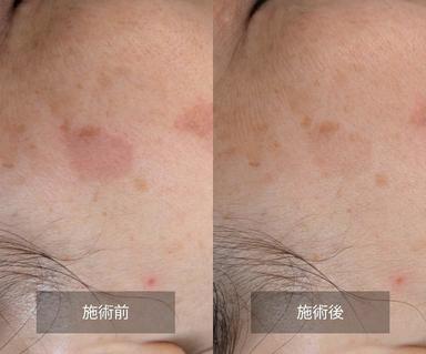 【本気のシミケア】気になる箇所に集中ケア 通常料金12000円