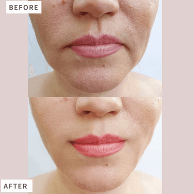 【新規限定クーポン】【当店おすすめ!!】幹細胞×エレポでシミ・しわ・美白改善コース通常料金30,000円