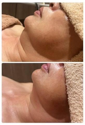 【新規限定】50%OFF！たるみ激変コース