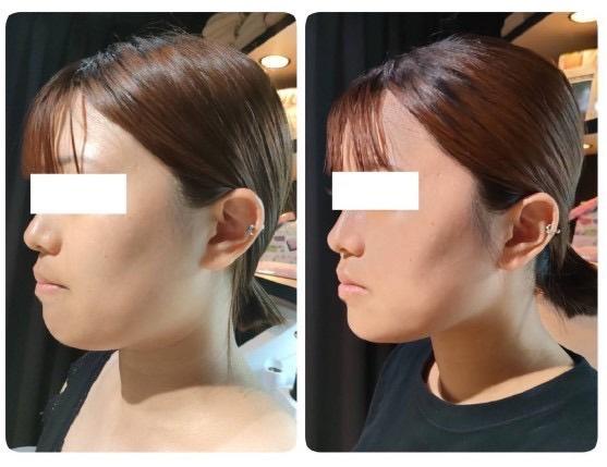 【再来限定】【小顔・たるみ改善】筋膜×筋肉アプローチ 