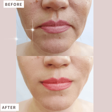 【6回コース】【当店おすすめ!!】幹細胞×エレポでシミ・しわ・美白改善コース通常料金30,000円