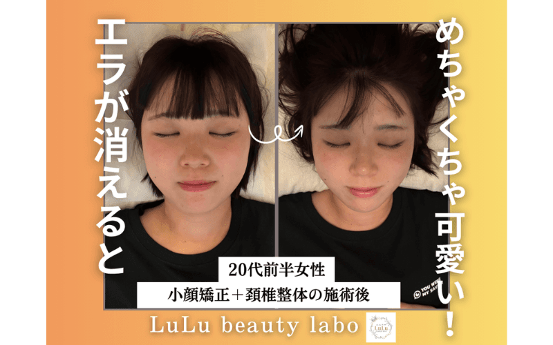 【中顔面短縮/エラ張りに】小顔矯正&頚椎整体《80分コース》¥13,200→¥6,600