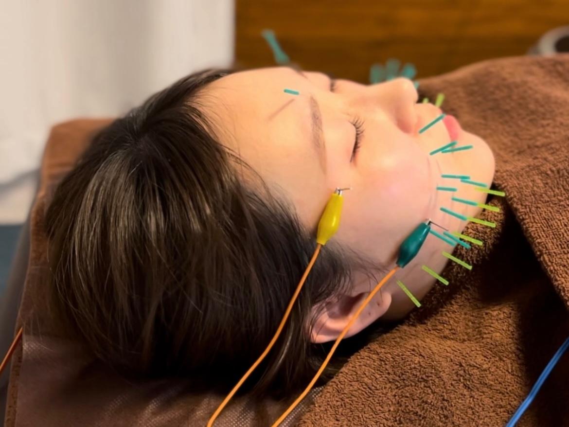 【新規限定】オーダーメイドケア【美容鍼＋鍼治療or整体付き 80分