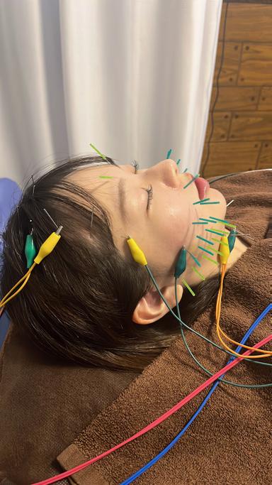 オーダーメイドケア美容鍼＋鍼治療（整体付き）80分