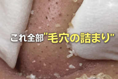 毛穴すっきり体験黒ずみごっそり除去（全顔）