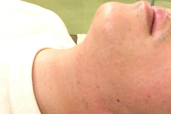 【全員OK】【学生割引】ヒゲ脱毛(鼻下からアゴライン) 10分 通常料金8,000円