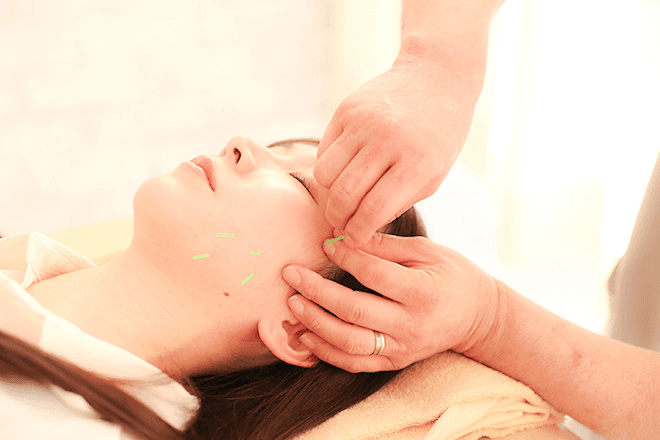 【新規限定】美容鍼 30分 通常料金3,900円