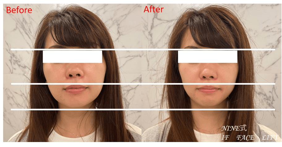 【NR機】　小顔矯正(60分)　12000円