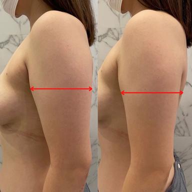 【NR機】二の腕改善(60分)　7000円