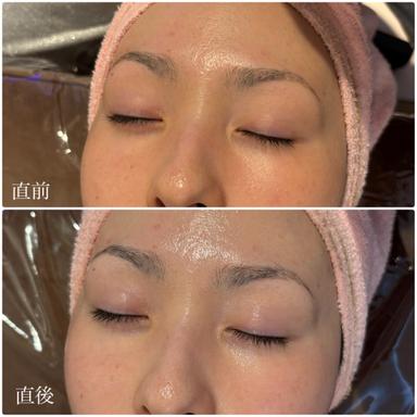 おすすめ！【水光肌ハーブピーリング＆美容液導入】剥離なし◎90分