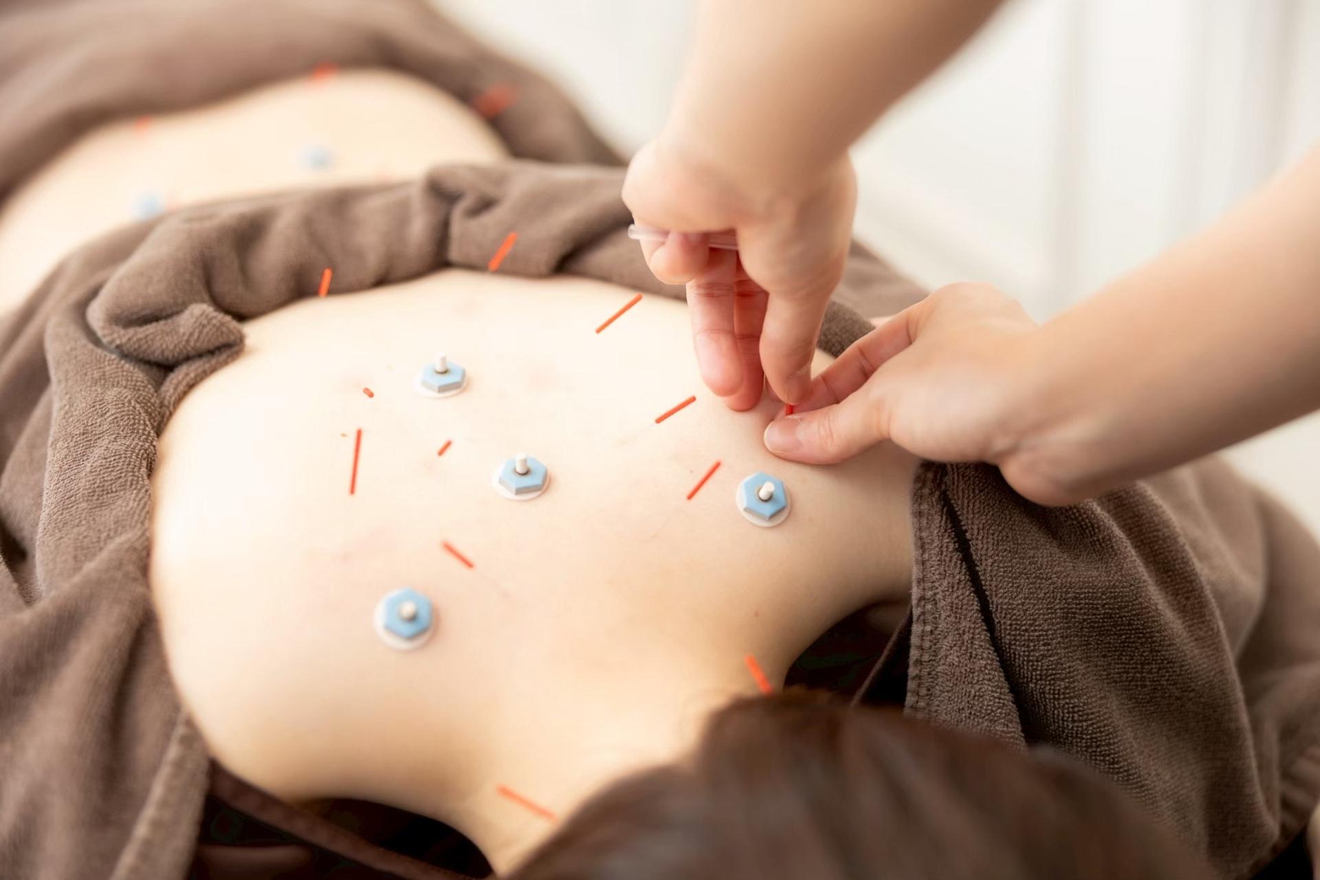 肩こり・腰痛・ぎっくりに【鍼灸(局所鍼) 】初回45分　通常8.000円→4,200円