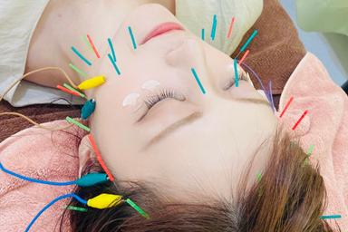 美容鍼スタンダード 30分