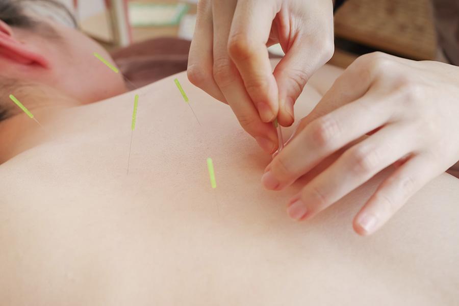 身体の鍼施術 30分