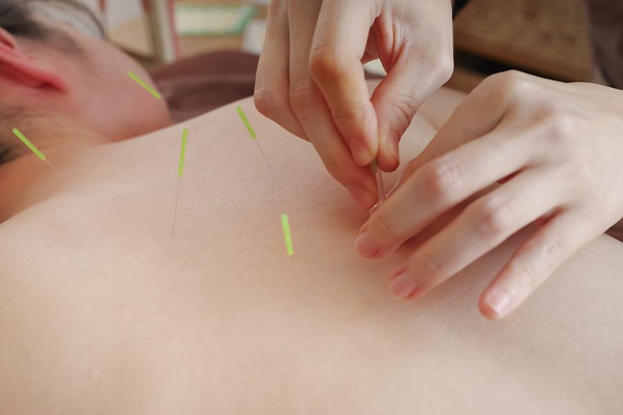 【新規限定】【鍼で全身ケア♪】全身鍼 60分 通常料金12,000円