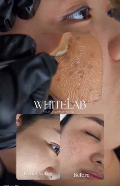 取れるだけメニュー★ホワイトラボ★7日後剥がす！塗るだけメラニンケア