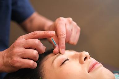 美容はり40分