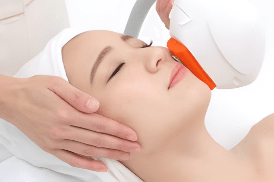 脱毛 顔全部 (OPT)