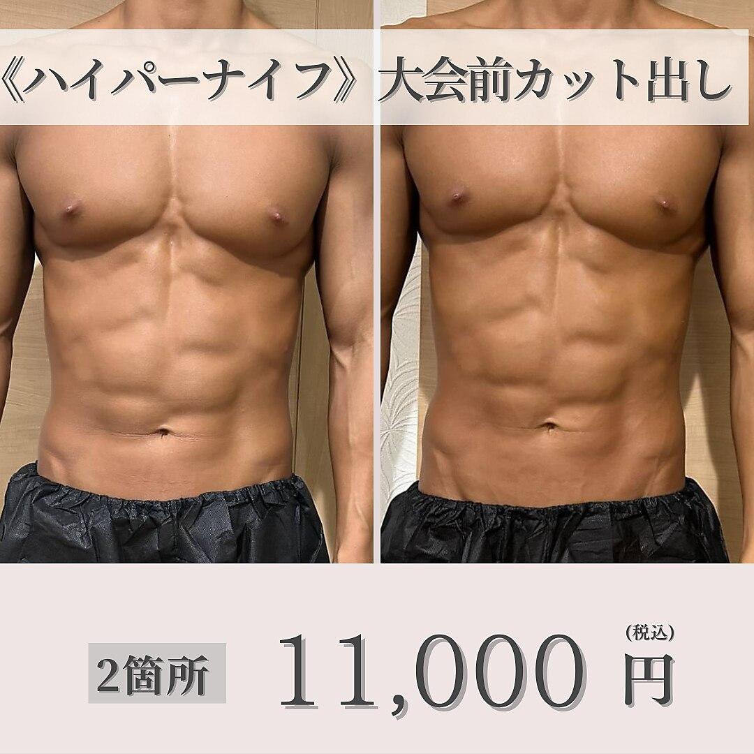 《ボディメイク・大会前に》オーダーメイドハイパーナイフカット出し 2箇所