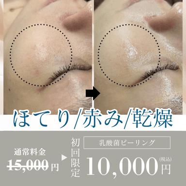 【初回お試し】ほてり/赤み/乾燥/夏の肌ストレスをリセット！乳酸菌ピーリング（デコルテ＋ヘッド付き）
