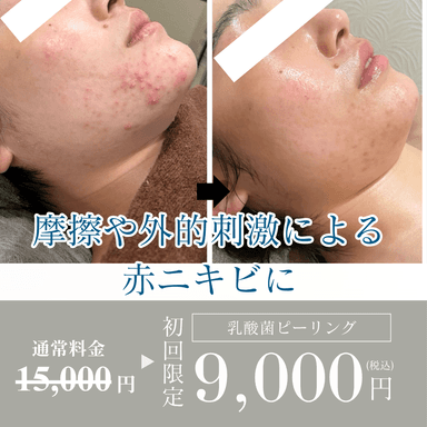 【初回お試し】揺らぎ肌レスキュー◎紫外線や赤みケア＆水分補給乳酸菌ピーリング