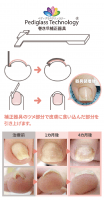 巻き爪補正カウンセリング